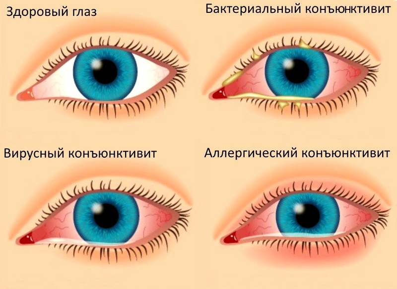 Болят глаза: причины и лечение