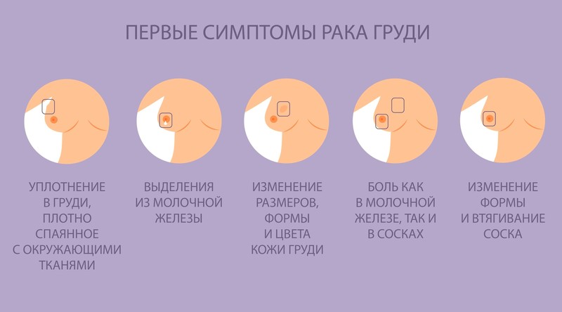 Киста молочной железы: диагностика та лечение в МЦ «Лелека», Киев