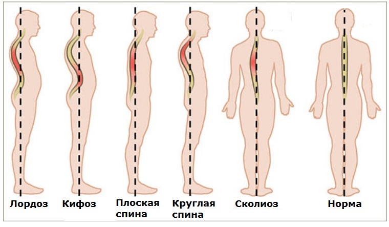 Почему важно делать вытяжение позвоночника