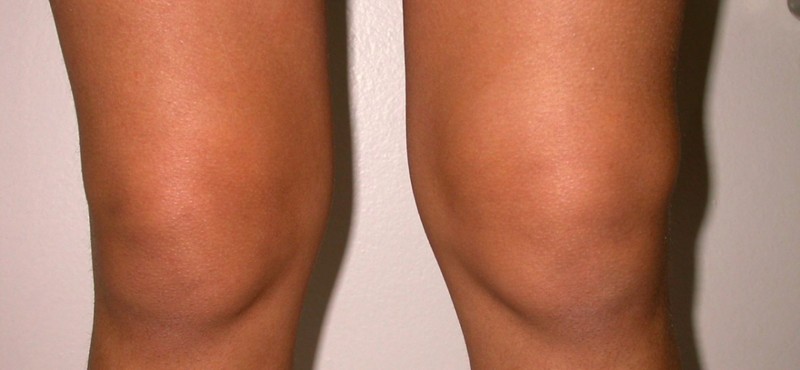 Отечность коленного сустава – это повод обратиться к врачу